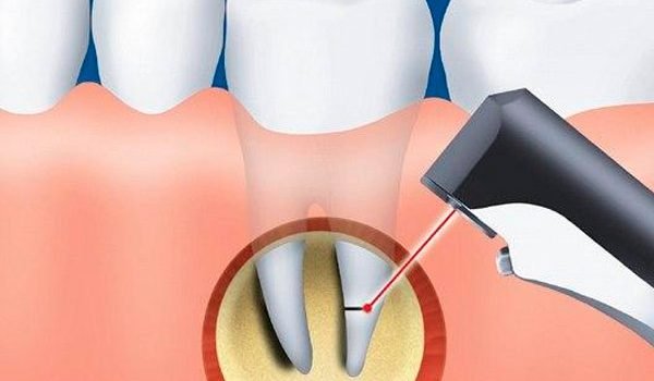 Diş kökü tedavisi